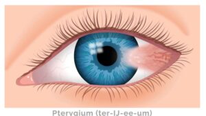 ALTIS may help with Surfer´s Eye